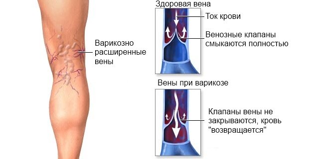 Варикозное расширение вен нижних конечностей. 