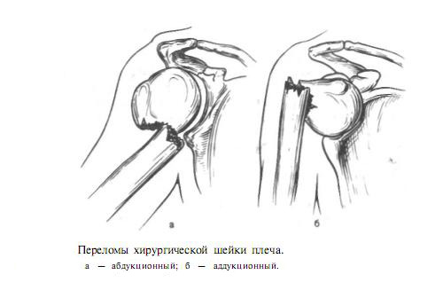 addukcionnyj-i-abdukcionnyj-perelom