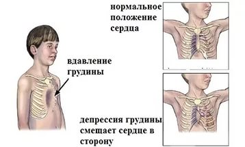 Виды деформации грудной клетки.