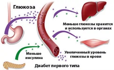 Сахарный диабет. Типы диабета. 