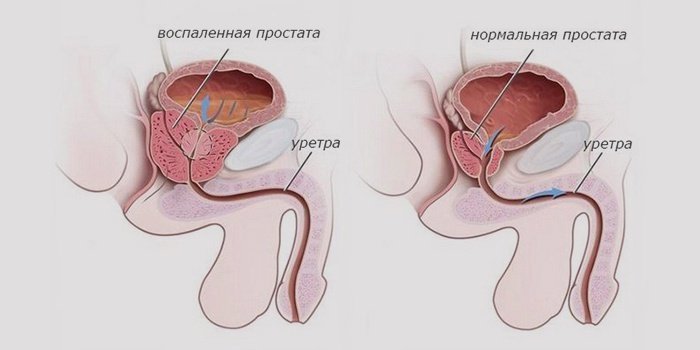 Причины воспаления предстательной железы.