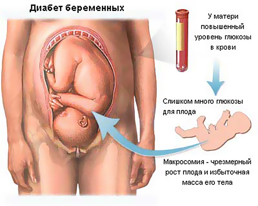 Сахарный диабет. Типы диабета. 