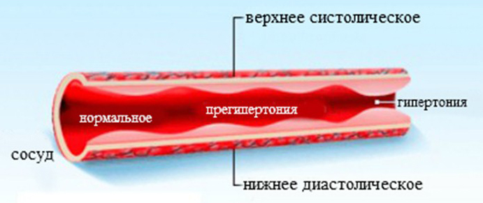 Гипертония