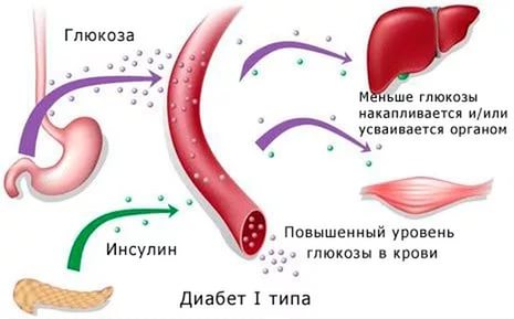 Сахарный диабет. Типы сахарного диабета.