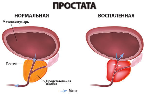 Лечение простатита. Основные симптомы простатита.