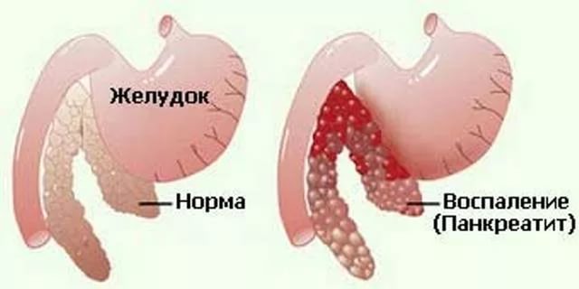 Диета при панкреатите. Запрещенные продукты.