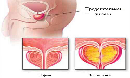 Диета при простатите.