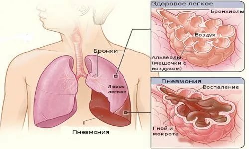 Пневмония. Гной. Мокрота.